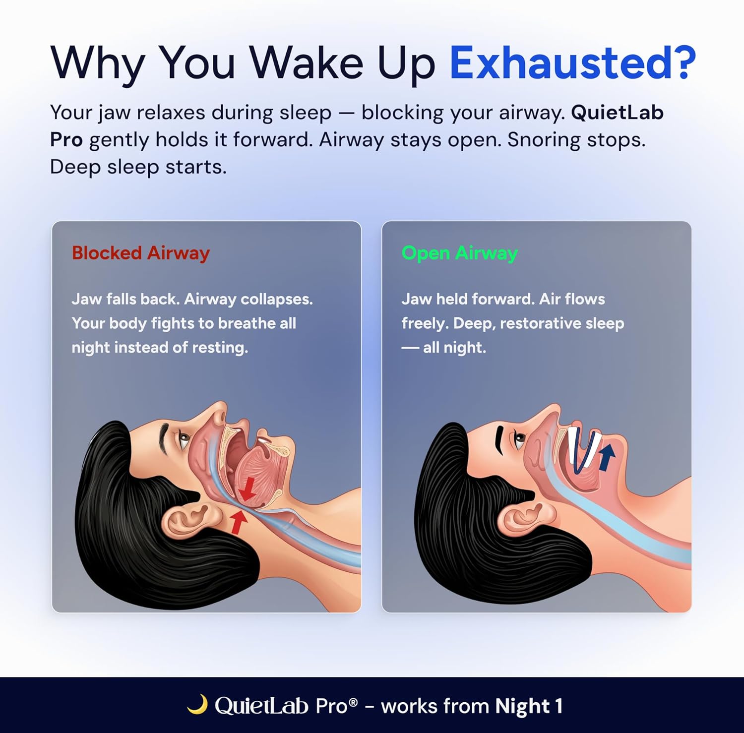 QuietLab Pro Anti-Snoring Mouthpiece - Adjustable Snoring Mouth Guard, Orthodontist Designed, No Boiling Required - BPA-Free Medical Grade - Designed for Nighttime Snoring Control